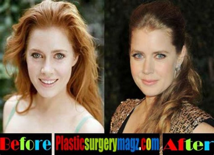Amy Adams Plastic Surgery Before and After