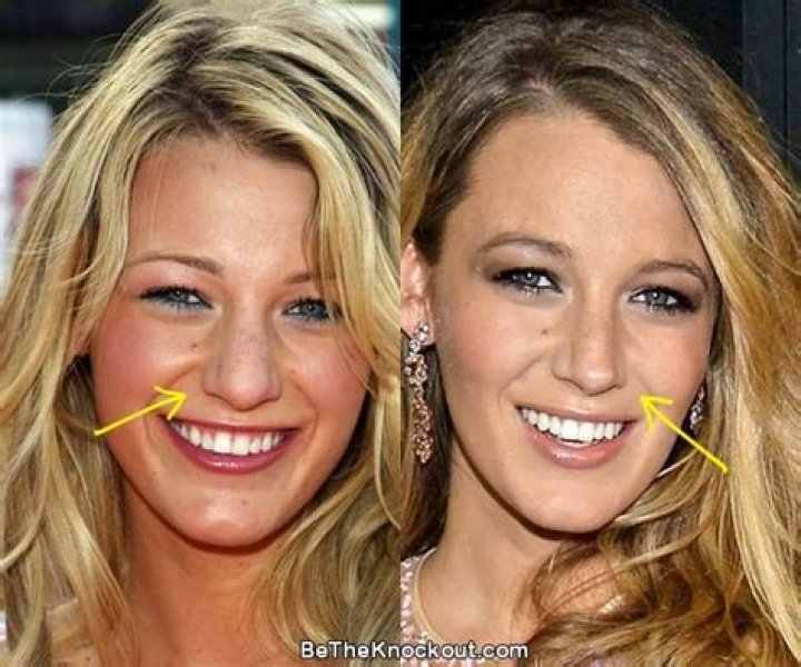 Blake Lively Breast Implants Plastic Surgery Before and After