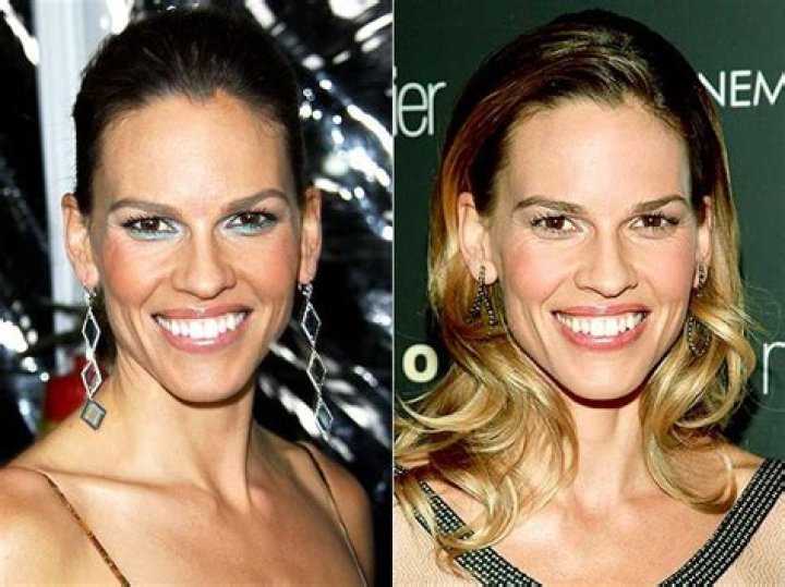 Hilary Swank Plastic Surgery Before and After