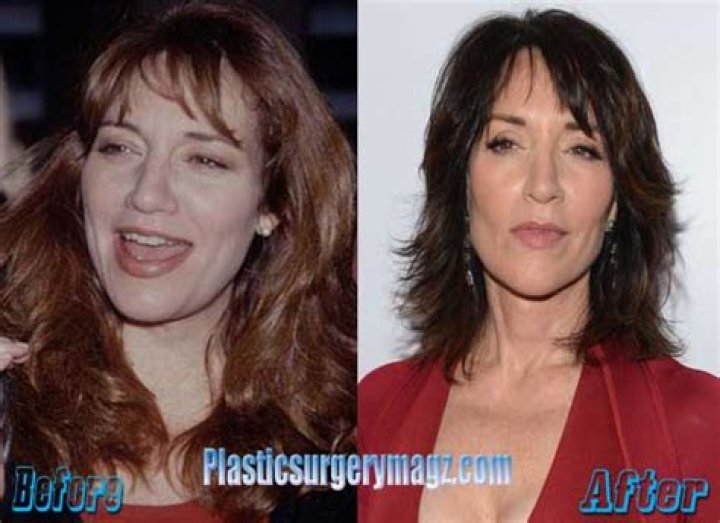 Katey Sagal Facelift Plastic Surgery Before and After