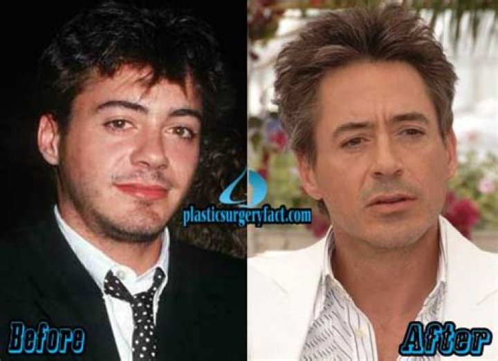 Robert Downey Jr. Plastic Surgery Before and After
