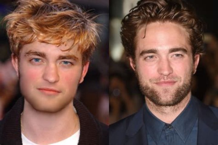 Robert Pattinson Plastic Surgery Before and After