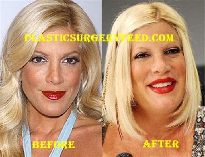 Tori Spelling Plastic Surgery Before and After